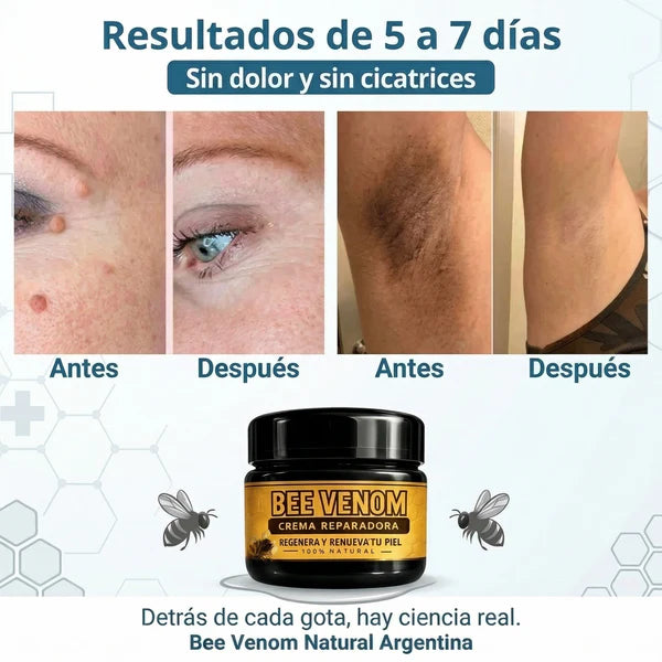 Elimina Verrugas y Papilomas Desde Casa, Sin Dolor y sin que vuelvan